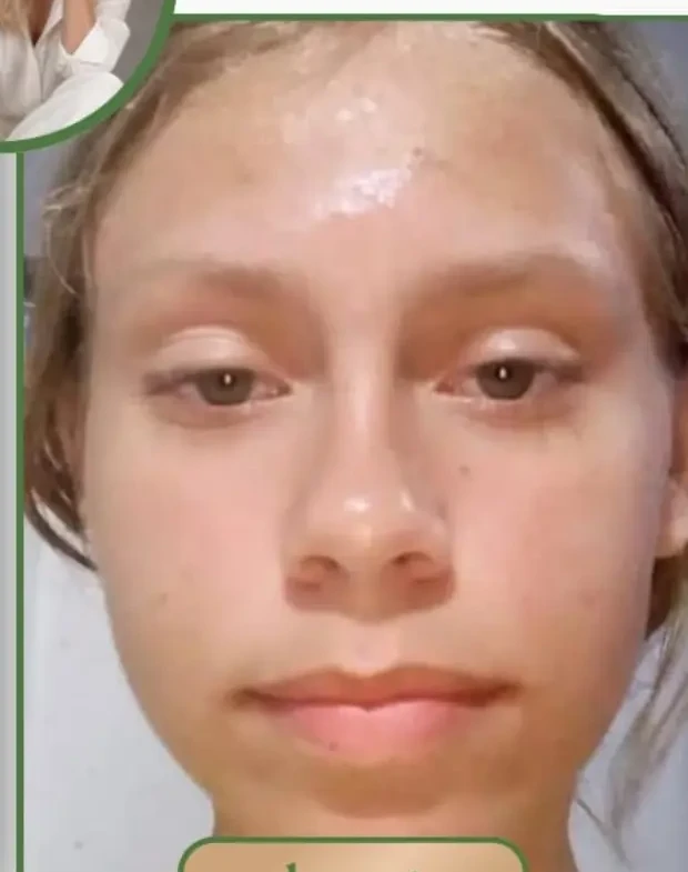 Pele depois do registro de atendimento